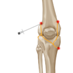 Advances in the treatment of knee pain